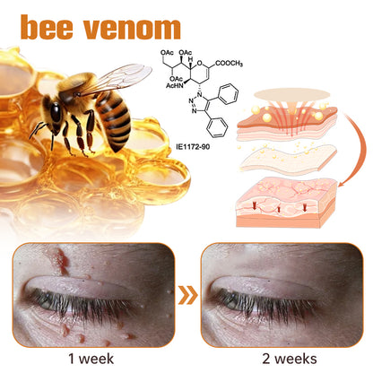 Ourlyard™ WartGone Bee Venom Treatment Patch